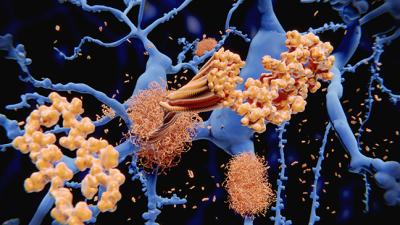 RPI Alzheimer’s Disease Research Program Gets Multimillion-Dollar Boost